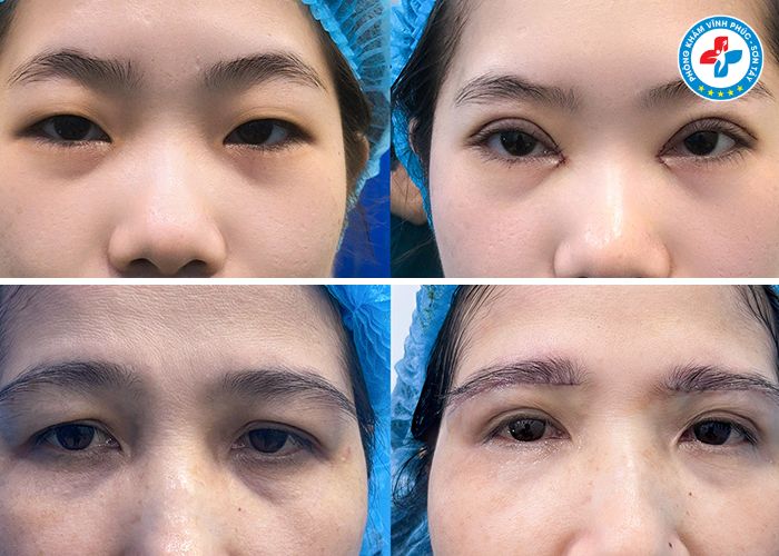 Treo cung mày tại Vĩnh Phúc (2) Treo cung mày tại Vĩnh Phúc (2)