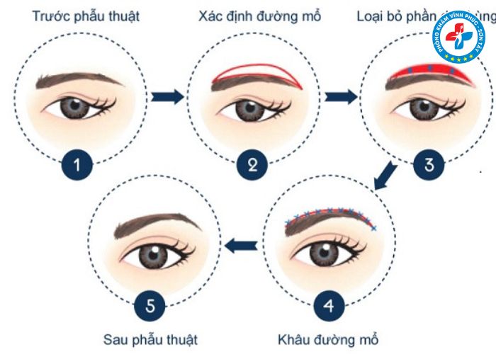 Treo cung mày tại Vĩnh Phúc (4) Treo cung mày tại Vĩnh Phúc (4)