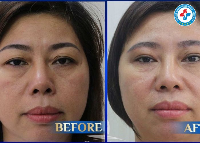 Treo cung mày tại Vĩnh Phúc Treo cung mày tại Vĩnh Phúc