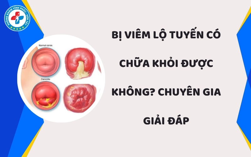 Viêm lộ tuyến có chữa khỏi được không