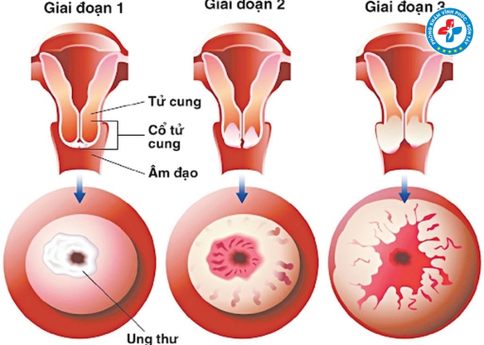 Viêm lộ tuyến có chữa khỏi được không (4) Viêm lộ tuyến có chữa khỏi được không (4)